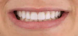 Depois - Dentes Pequenos